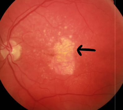 Geographic Atrophy Ga Retina Australia