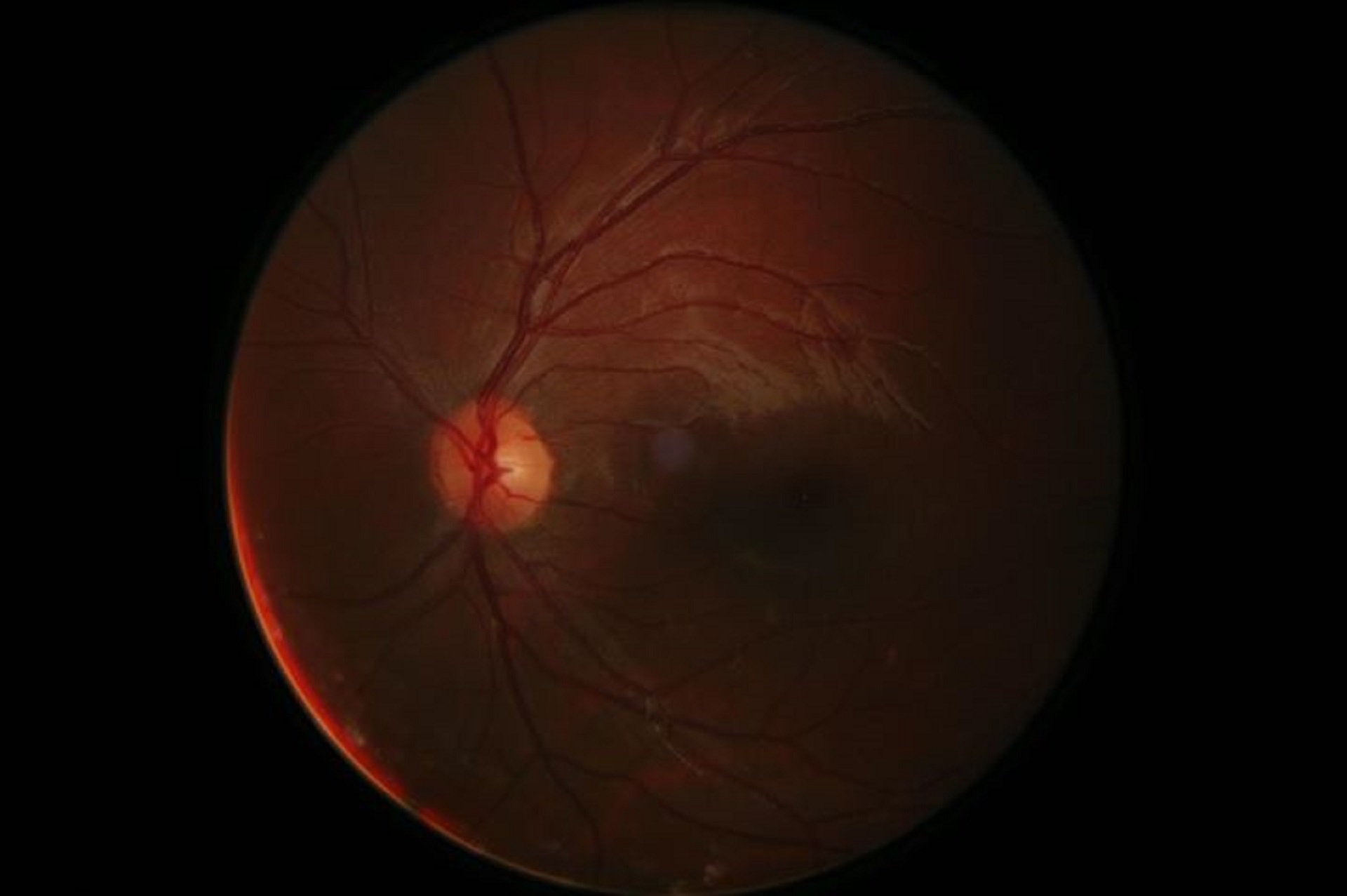 Best disease - Retina Australia