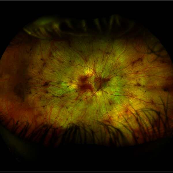 Image of a retina with choroideremia