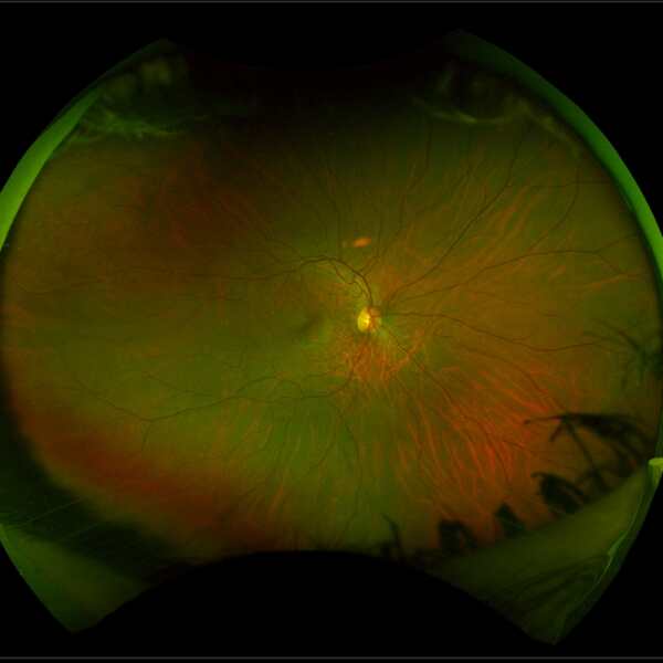 Image of a healthy retina