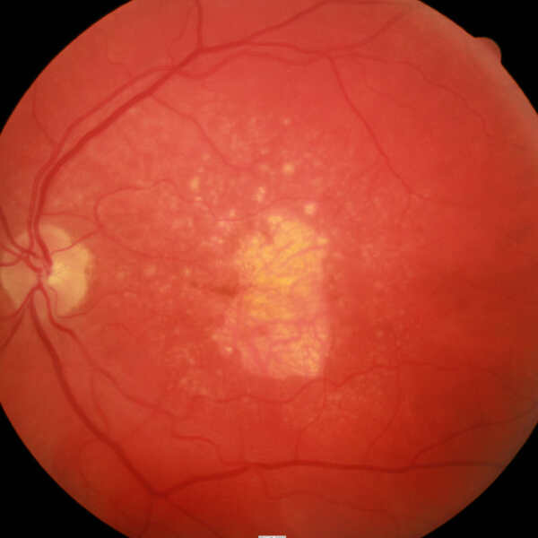 Late stage atrophic age related macular degeneration