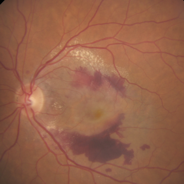 Late-stage-neovascular-age-related-macular-degeneration
