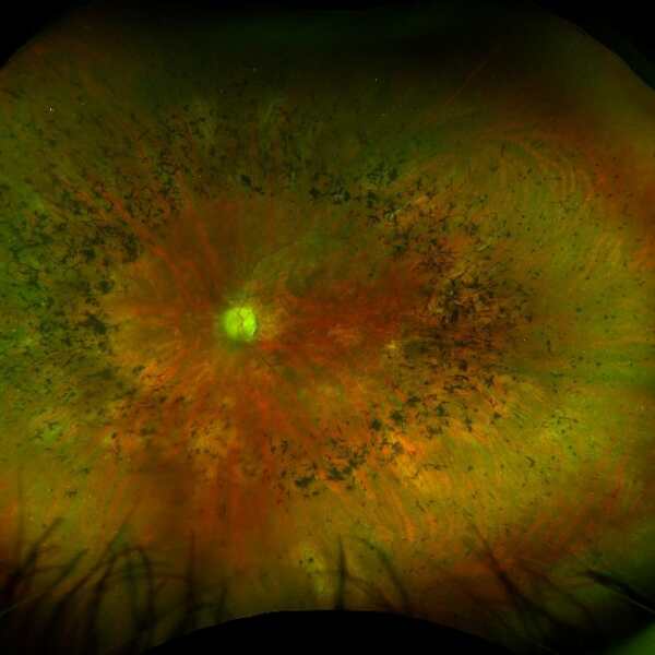 Appearance of a retina with retinitis pigmentosa